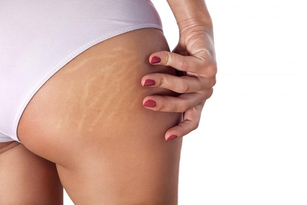 Spots, Scars, and Stretch Marks: Lasers Can Treat Them All